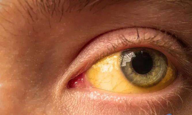 以眼珠发蓝是什么症状？（了解眼珠发蓝的原因和治疗方法）