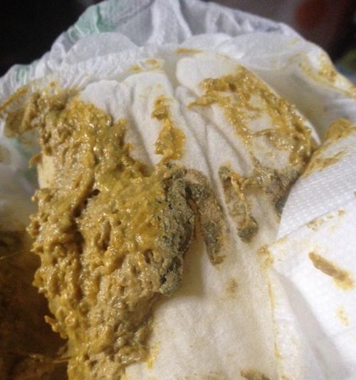大便紫黑色的原因及相关健康问题（揭秘大便紫黑色的原因，了解健康隐患）