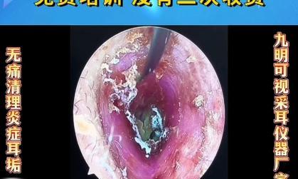 清洗耳朵的正确方法（选择适合的方式，关爱你的听觉健康）