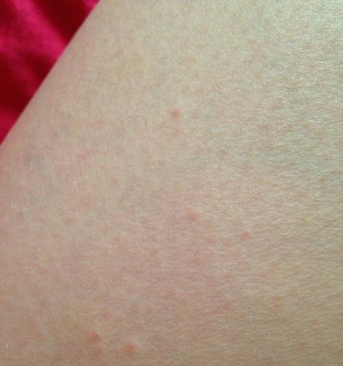 疱疹病毒引起的身上痒与红点（探究疱疹病毒的传播途径和预防方法）