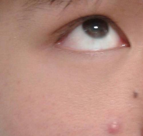 红眼病情分析（探寻下眼睑红肿的病因与治疗方法）