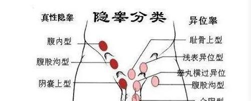 睾丸缺失对人体的影响（了解睾丸缺失的影响，维护男性健康）