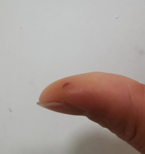 仓鼠咬后可能传播的疾病（了解仓鼠咬伤后可能引发的健康问题）