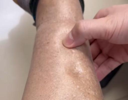 狗肝腹水症状解析（了解狗肝腹水症状及其危害，关心宠物健康）